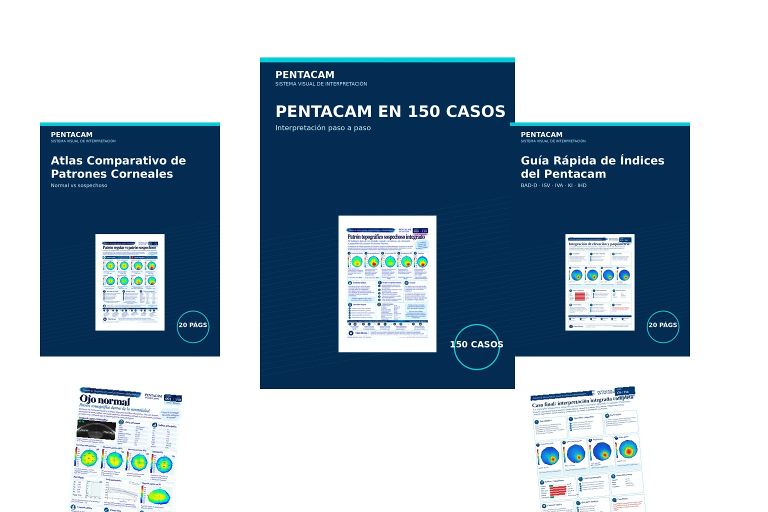 Pentacam en 150 Casos